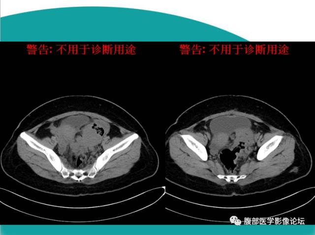 【病例】直肠副神经节细胞瘤1例CT及MR 【病例】直肠副神经节细胞瘤1例CT及MR