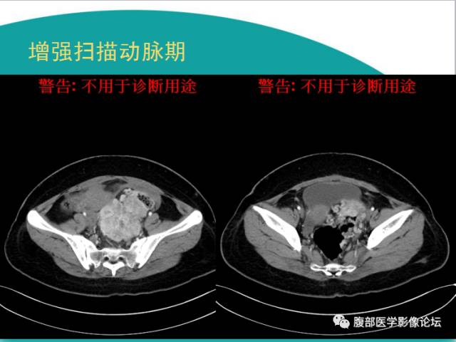 【病例】直肠副神经节细胞瘤1例CT及MR 【病例】直肠副神经节细胞瘤1例CT及MR