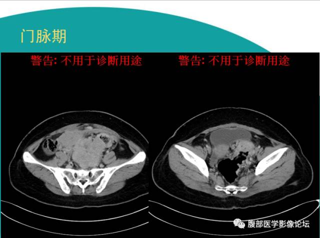 【病例】直肠副神经节细胞瘤1例CT及MR 【病例】直肠副神经节细胞瘤1例CT及MR