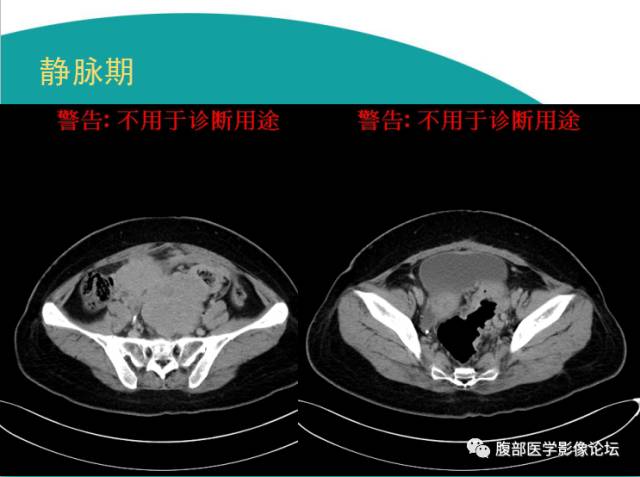 【病例】直肠副神经节细胞瘤1例CT及MR 【病例】直肠副神经节细胞瘤1例CT及MR