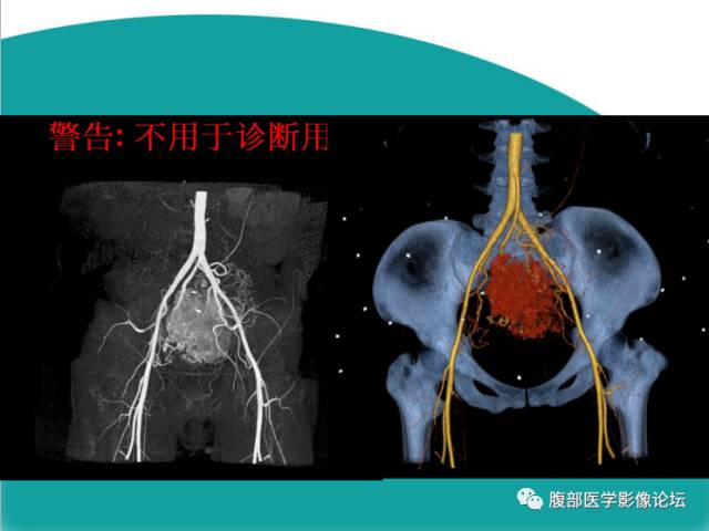 【病例】直肠副神经节细胞瘤1例CT及MR 【病例】直肠副神经节细胞瘤1例CT及MR