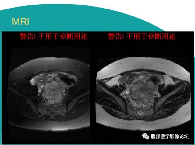 【病例】直肠副神经节细胞瘤1例CT及MR 【病例】直肠副神经节细胞瘤1例CT及MR