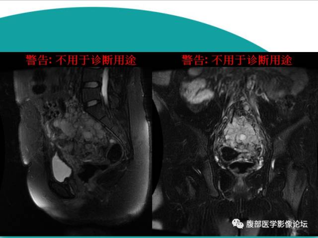 【病例】直肠副神经节细胞瘤1例CT及MR 【病例】直肠副神经节细胞瘤1例CT及MR