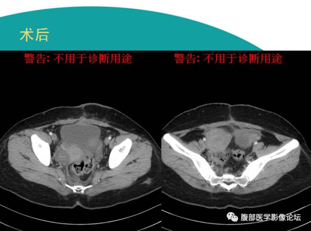 【病例】直肠副神经节细胞瘤1例CT及MR 【病例】直肠副神经节细胞瘤1例CT及MR