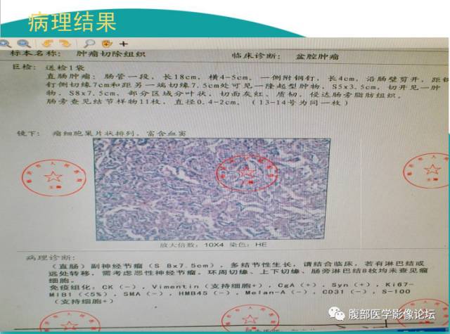 【病例】直肠副神经节细胞瘤1例CT及MR 【病例】直肠副神经节细胞瘤1例CT及MR