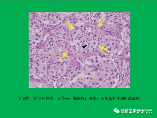 【病例】直肠副神经节细胞瘤1例CT及MR 【病例】直肠副神经节细胞瘤1例CT及MR
