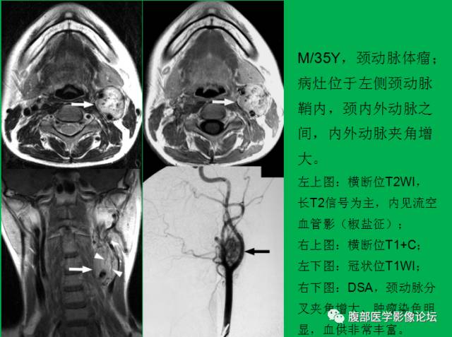 【病例】直肠副神经节细胞瘤1例CT及MR 【病例】直肠副神经节细胞瘤1例CT及MR