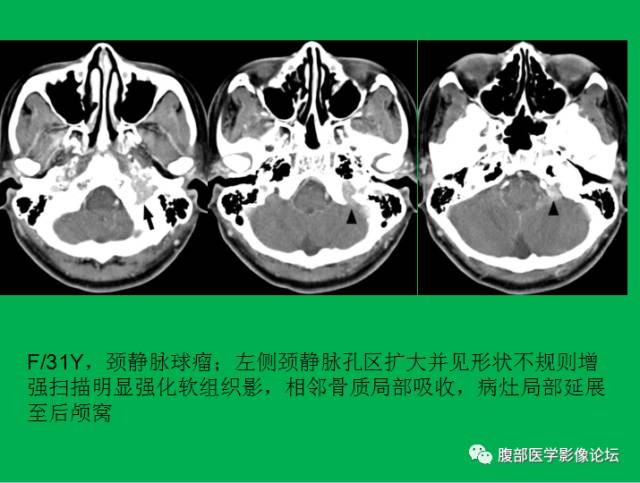 【病例】直肠副神经节细胞瘤1例CT及MR 【病例】直肠副神经节细胞瘤1例CT及MR