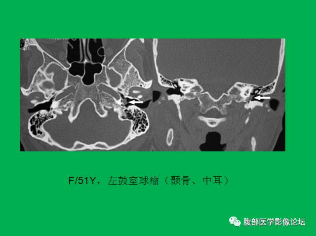 【病例】直肠副神经节细胞瘤1例CT及MR 【病例】直肠副神经节细胞瘤1例CT及MR