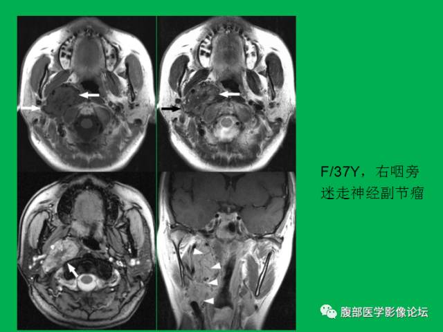 【病例】直肠副神经节细胞瘤1例CT及MR 【病例】直肠副神经节细胞瘤1例CT及MR