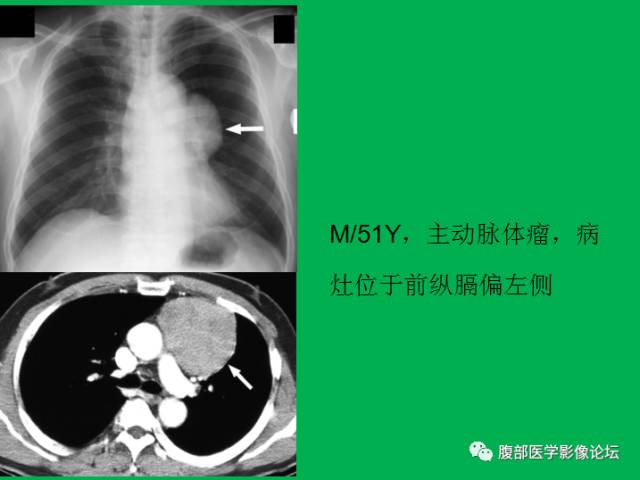 【病例】直肠副神经节细胞瘤1例CT及MR 【病例】直肠副神经节细胞瘤1例CT及MR