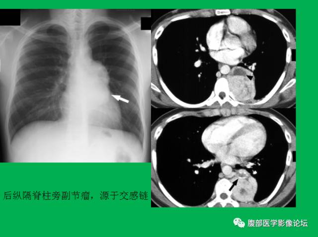 【病例】直肠副神经节细胞瘤1例CT及MR 【病例】直肠副神经节细胞瘤1例CT及MR