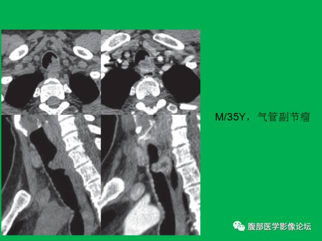 【病例】直肠副神经节细胞瘤1例CT及MR 【病例】直肠副神经节细胞瘤1例CT及MR