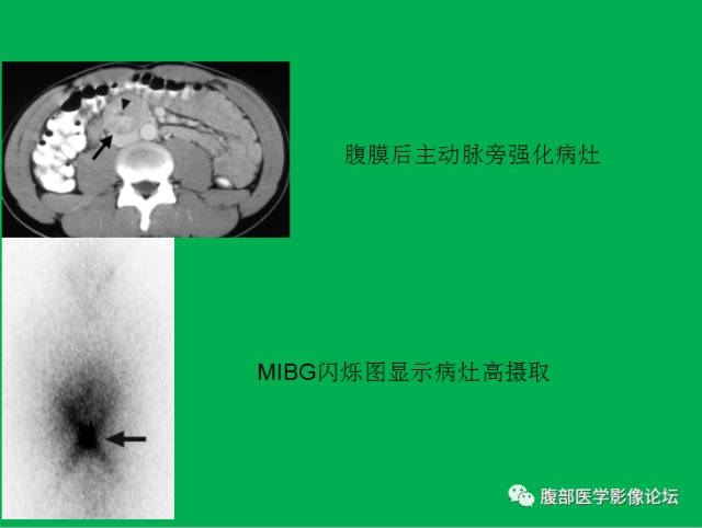 【病例】直肠副神经节细胞瘤1例CT及MR 【病例】直肠副神经节细胞瘤1例CT及MR