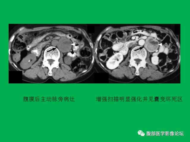 【病例】直肠副神经节细胞瘤1例CT及MR 【病例】直肠副神经节细胞瘤1例CT及MR