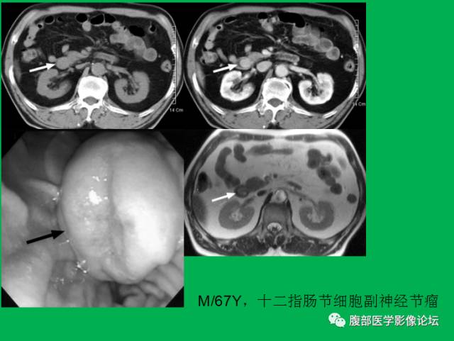 【病例】直肠副神经节细胞瘤1例CT及MR 【病例】直肠副神经节细胞瘤1例CT及MR