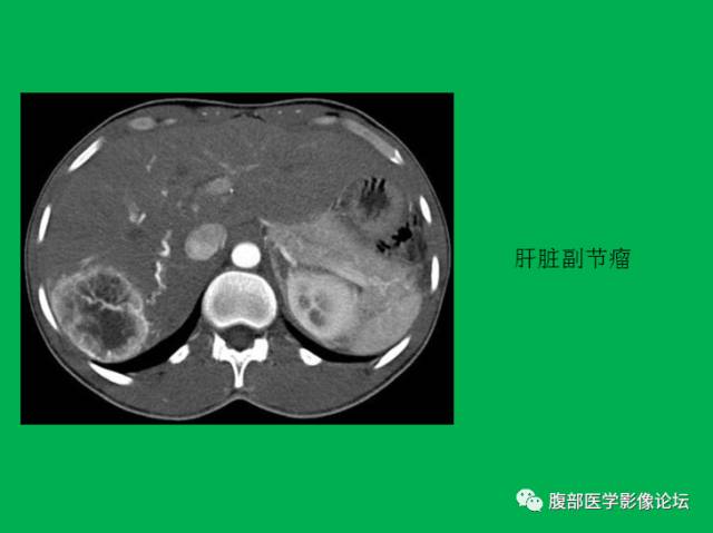 【病例】直肠副神经节细胞瘤1例CT及MR 【病例】直肠副神经节细胞瘤1例CT及MR
