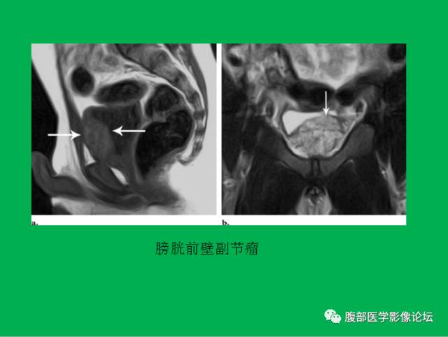 【病例】直肠副神经节细胞瘤1例CT及MR 【病例】直肠副神经节细胞瘤1例CT及MR