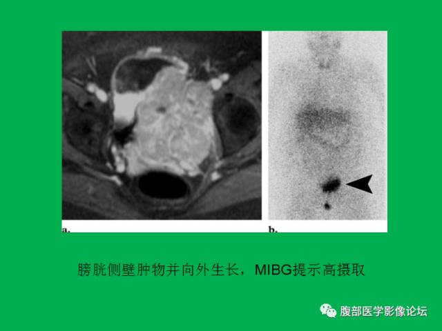 【病例】直肠副神经节细胞瘤1例CT及MR 【病例】直肠副神经节细胞瘤1例CT及MR
