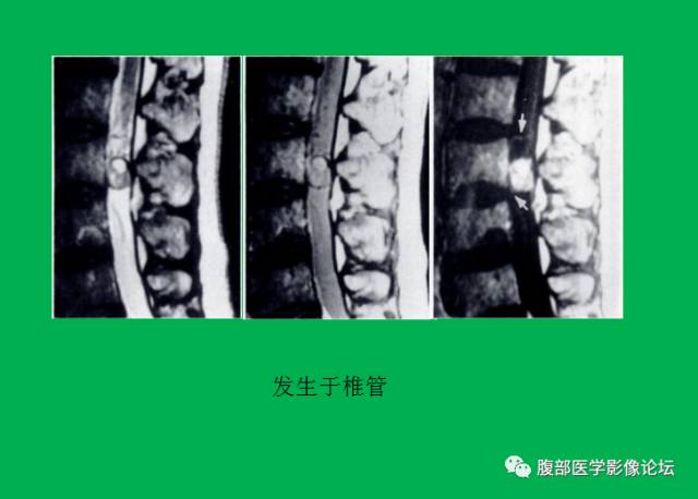 【病例】直肠副神经节细胞瘤1例CT及MR 【病例】直肠副神经节细胞瘤1例CT及MR