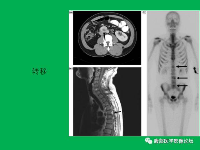 【病例】直肠副神经节细胞瘤1例CT及MR 【病例】直肠副神经节细胞瘤1例CT及MR
