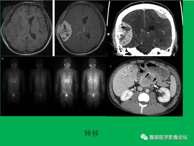 【病例】直肠副神经节细胞瘤1例CT及MR 【病例】直肠副神经节细胞瘤1例CT及MR