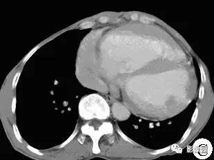 【病例】室间隔缺损伴肺动脉高压1例X线CT 【病例】室间隔缺损伴肺动脉高压1例X线CT