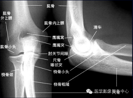 歪戴帽征及八字征 歪戴帽征及八字征