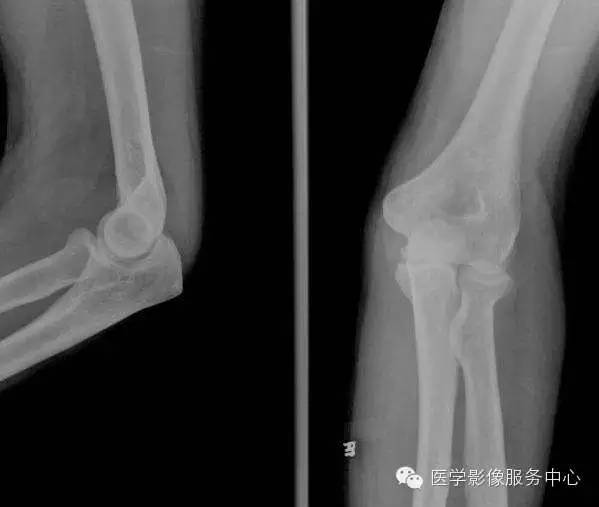 歪戴帽征及八字征 歪戴帽征及八字征