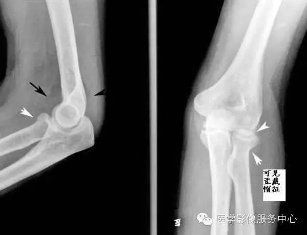 歪戴帽征及八字征