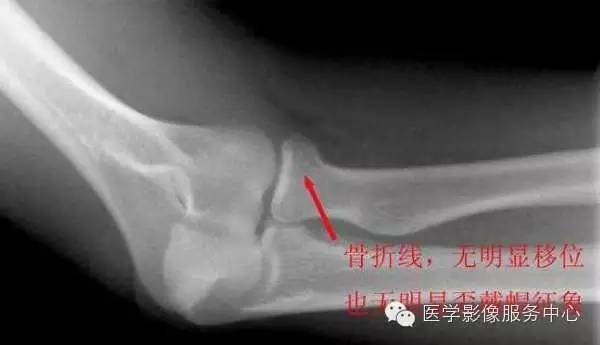 歪戴帽征及八字征 歪戴帽征及八字征