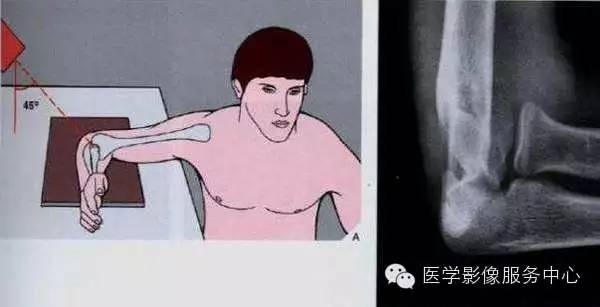 歪戴帽征及八字征 歪戴帽征及八字征