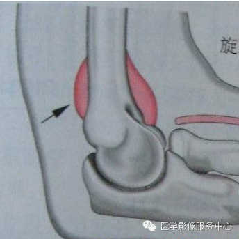 歪戴帽征及八字征 歪戴帽征及八字征