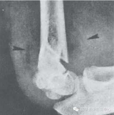 歪戴帽征及八字征 歪戴帽征及八字征