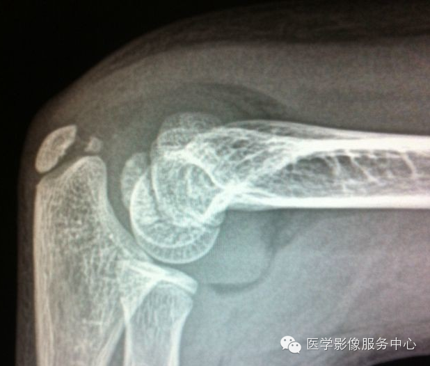 歪戴帽征及八字征 歪戴帽征及八字征