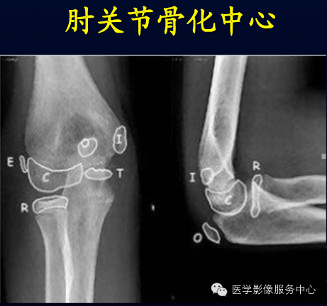歪戴帽征及八字征 歪戴帽征及八字征