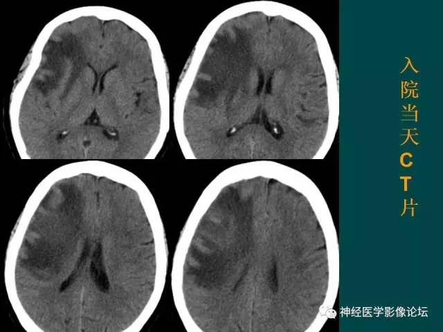 【病例】右额叶出血性脑梗死1例CT及MR影像表现
