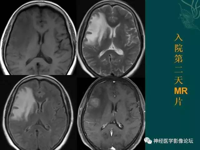 【病例】右额叶出血性脑梗死1例CT及MR影像表现