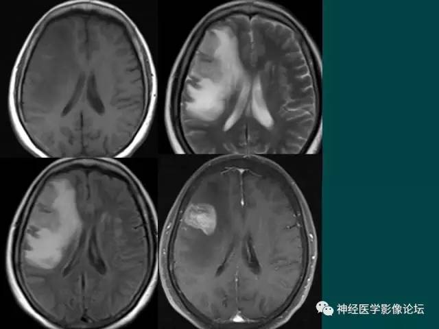 【病例】右额叶出血性脑梗死1例CT及MR影像表现