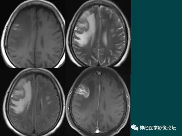 【病例】右额叶出血性脑梗死1例CT及MR影像表现