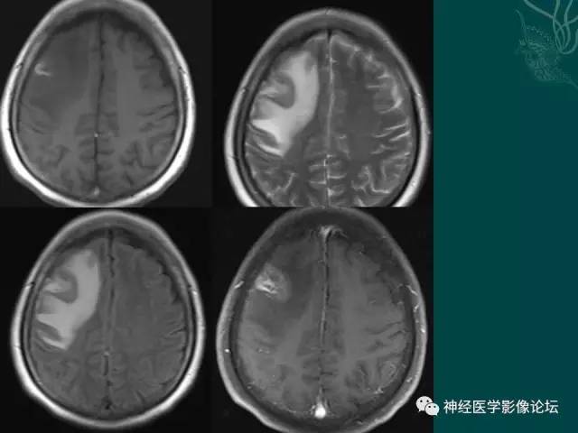 【病例】右额叶出血性脑梗死1例CT及MR影像表现