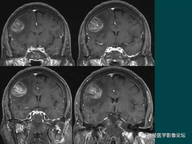 【病例】右额叶出血性脑梗死1例CT及MR影像表现