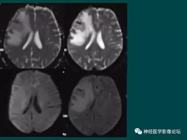 【病例】右额叶出血性脑梗死1例CT及MR影像表现