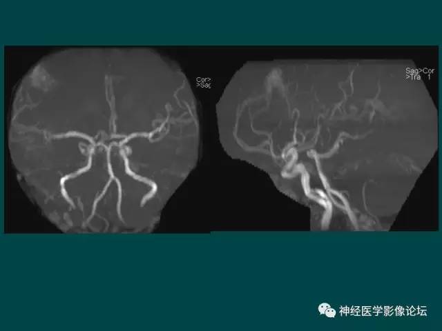 【病例】右额叶出血性脑梗死1例CT及MR影像表现