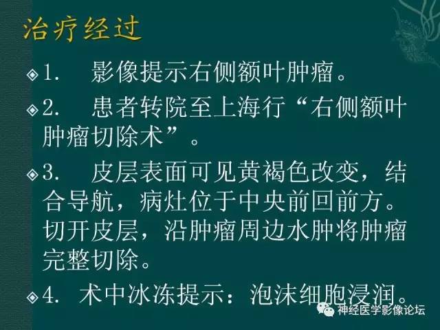 【病例】右额叶出血性脑梗死1例CT及MR影像表现
