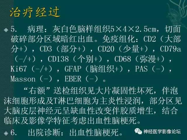【病例】右额叶出血性脑梗死1例CT及MR影像表现