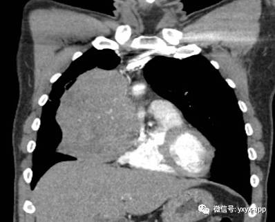 【病例】纵隔胸腺瘤1例X线CT影像表现 【病例】纵隔胸腺瘤1例X线CT影像表现