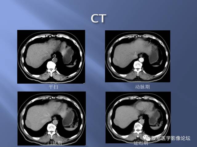 【病例】肝周恶性间皮瘤1例CT及MR影像表现 【病例】肝周恶性间皮瘤1例CT及MR影像表现