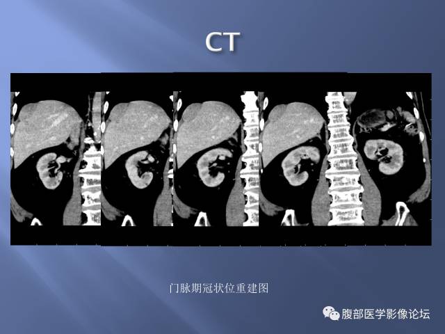【病例】肝周恶性间皮瘤1例CT及MR影像表现 【病例】肝周恶性间皮瘤1例CT及MR影像表现
