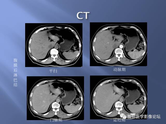 【病例】肝周恶性间皮瘤1例CT及MR影像表现 【病例】肝周恶性间皮瘤1例CT及MR影像表现
